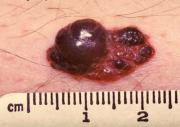 El peligro de los lunares y el cáncer